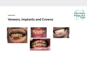 Veneers, Implants and Crowns